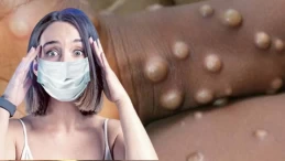 Dünya gündemine oturan ‘maymun çiçeği’ hastalığı bilimeyenleri